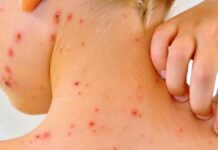 Detectan 22 casos de sarampión en el Edomex, refuerzan jornadas de vacunación Sarampion-enfermedad