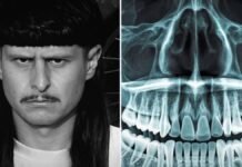 Identificación de Oliver Tree mediante registros dentales Identificación de Oliver Tree mediante registros dentales